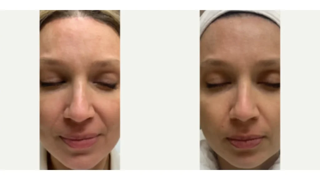 A patient's before and after photo of their PRP treatment for their face.