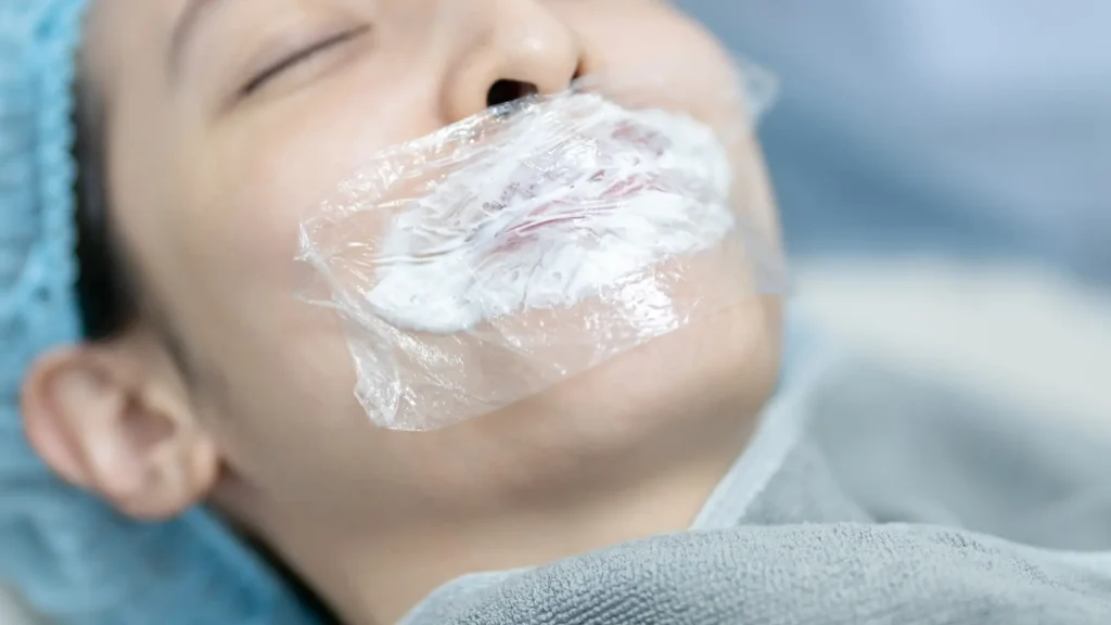 An individual with numbing cream and occlusive dressing on their lips.