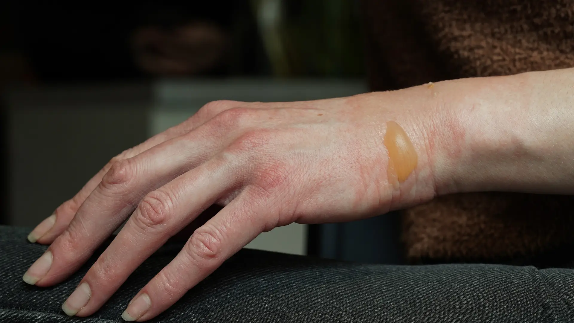 An individual dealing with first-degree burns.