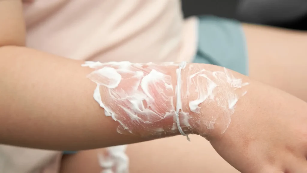 An individual with cream applied on open wound.