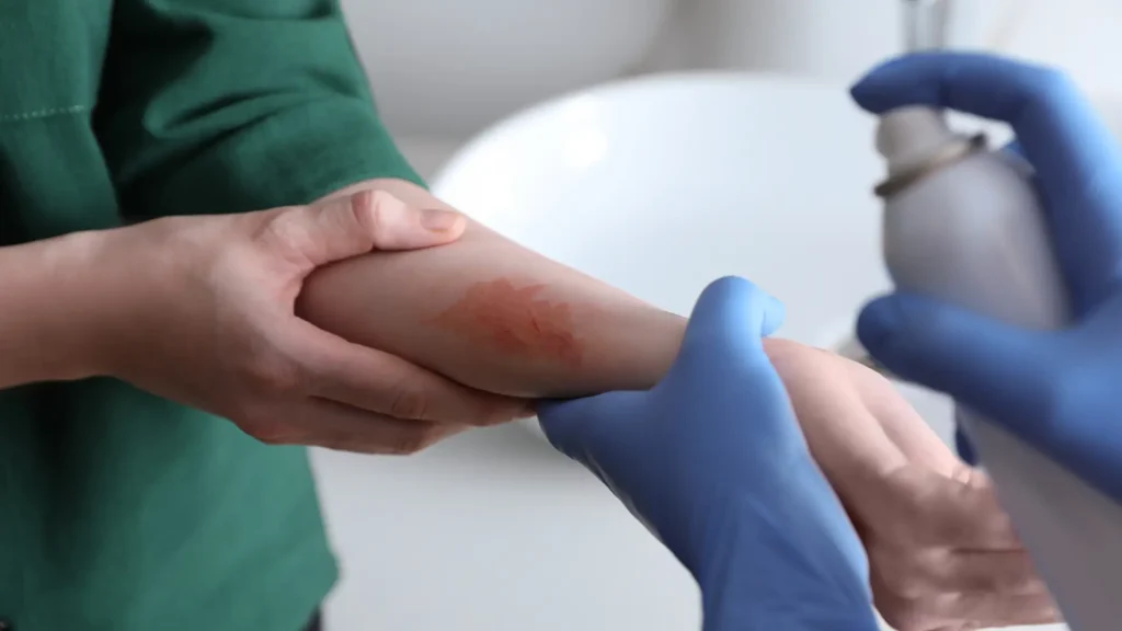 A medical professional preparing to apply a burn spray on the patient's skin.
