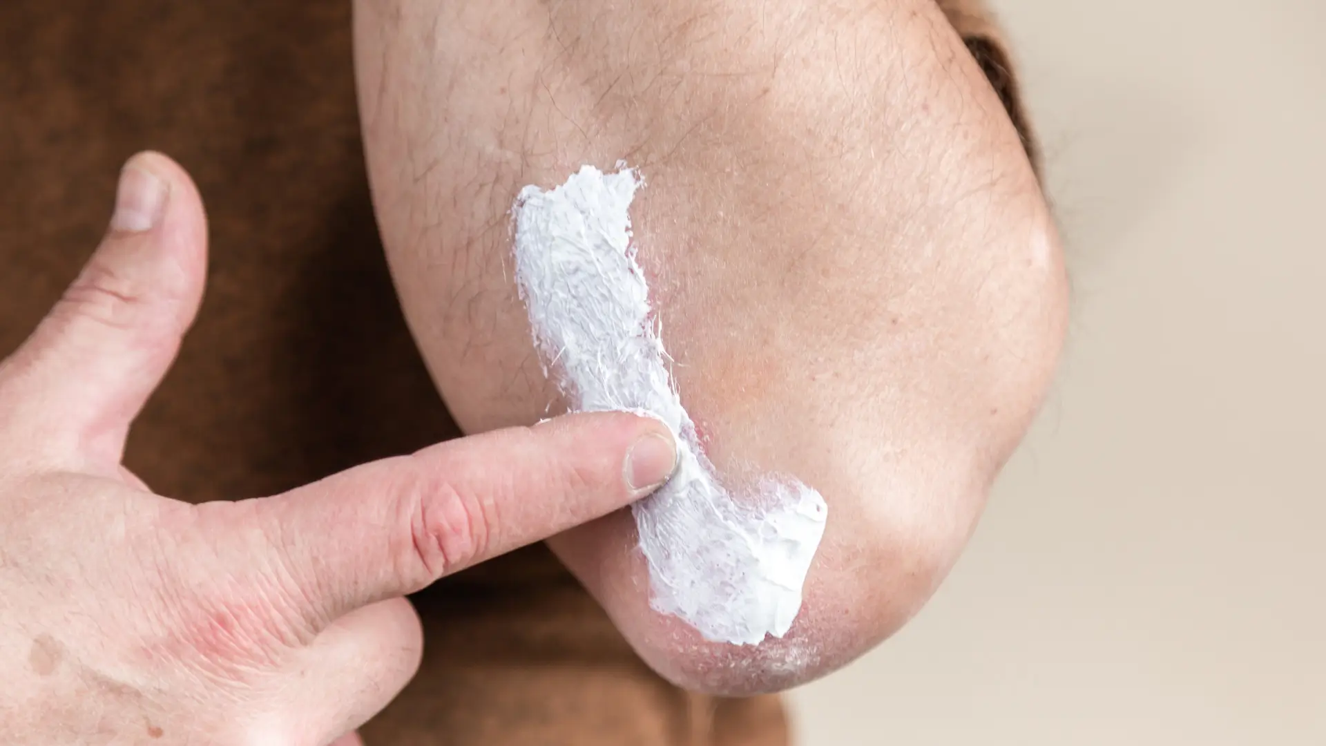 An individual with topical medicine cream on their elbow.