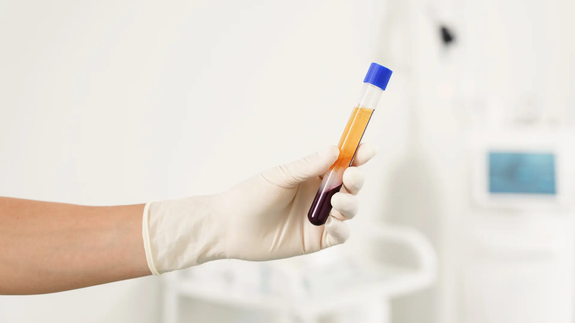 A vacutainer with platelet-rich plasma and blood for treatment.