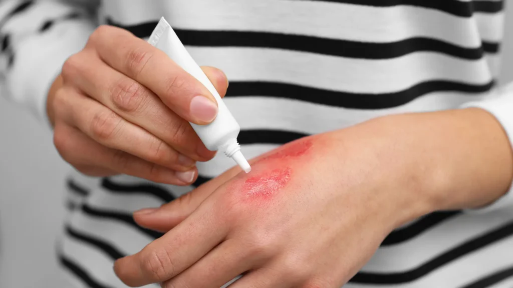 An individual applying a solution to the burned area on their hand.