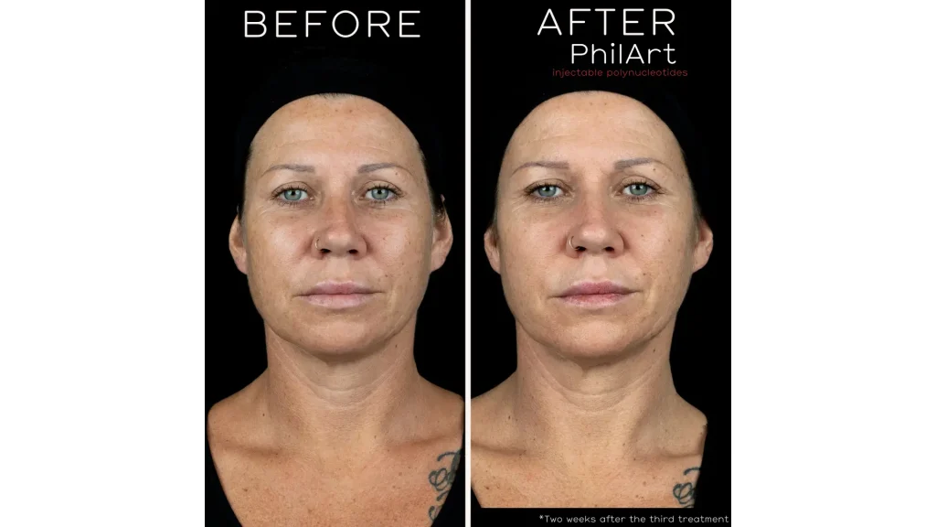 A Philart-treated patient's before and after photo showing their fine line and pigmentation improvement​s.