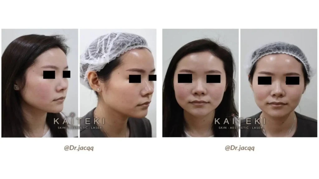 A patient's before and after photo after two sessions of Plinest for their rosacea.