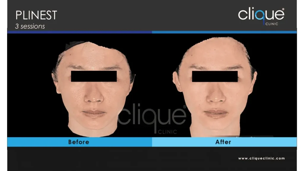 A Plinest-treated patient's before and after photo of their improved facial texture and aging signs.
