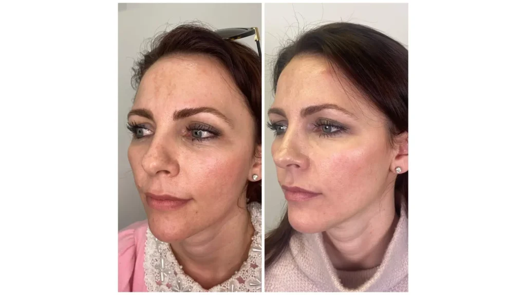 A before and after photo of a Profhilo-treated patient in their facial region.