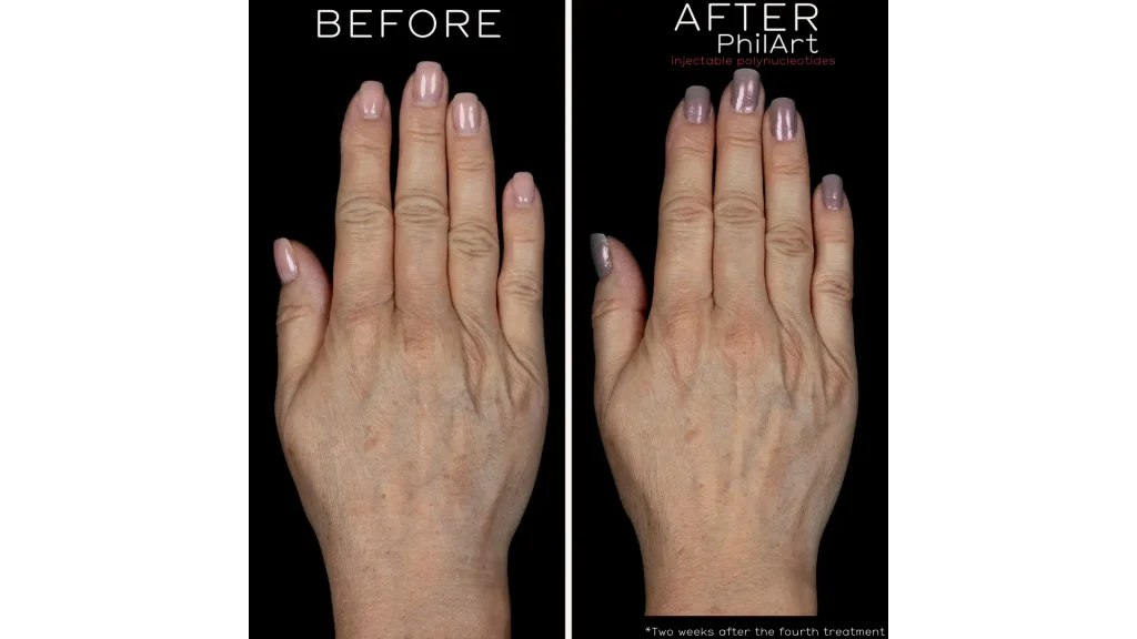 A patient's before and after treatment of their hands.