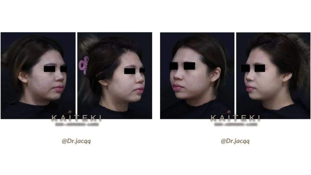 A patient's before and after photo of their Plinest treatment after one session for their hormonal acne.