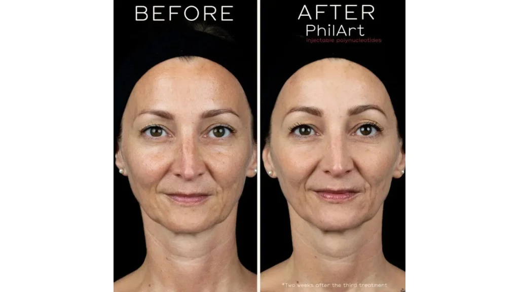 A before and after photo of a patient's facial treatment with PhilArt injections.