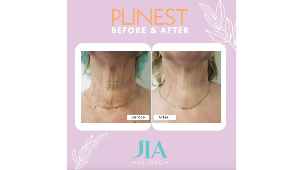 A patient's before and after photo of their neck region after their Plinest treatment.