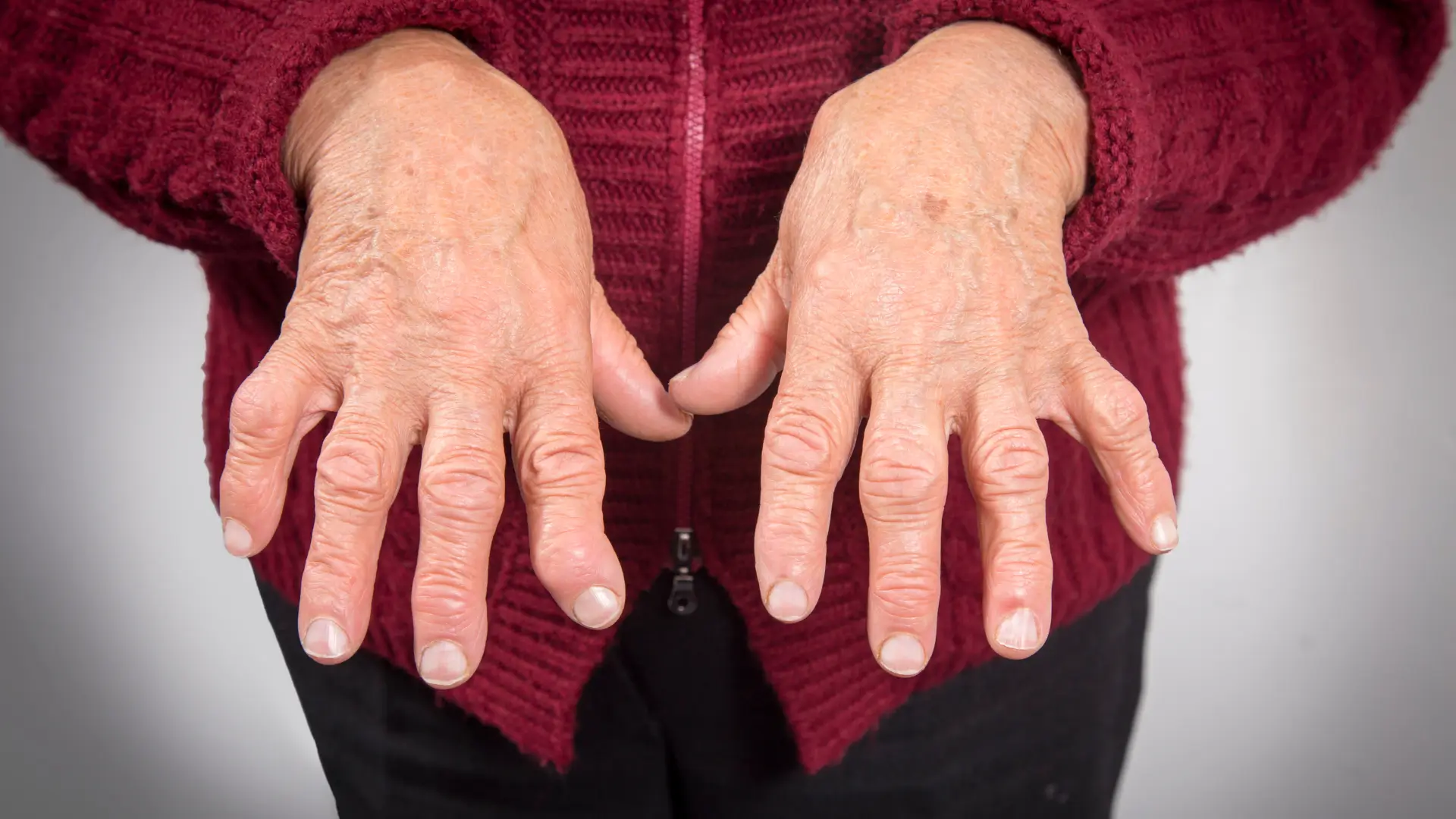 An individual with rheumatoid arthritis.
