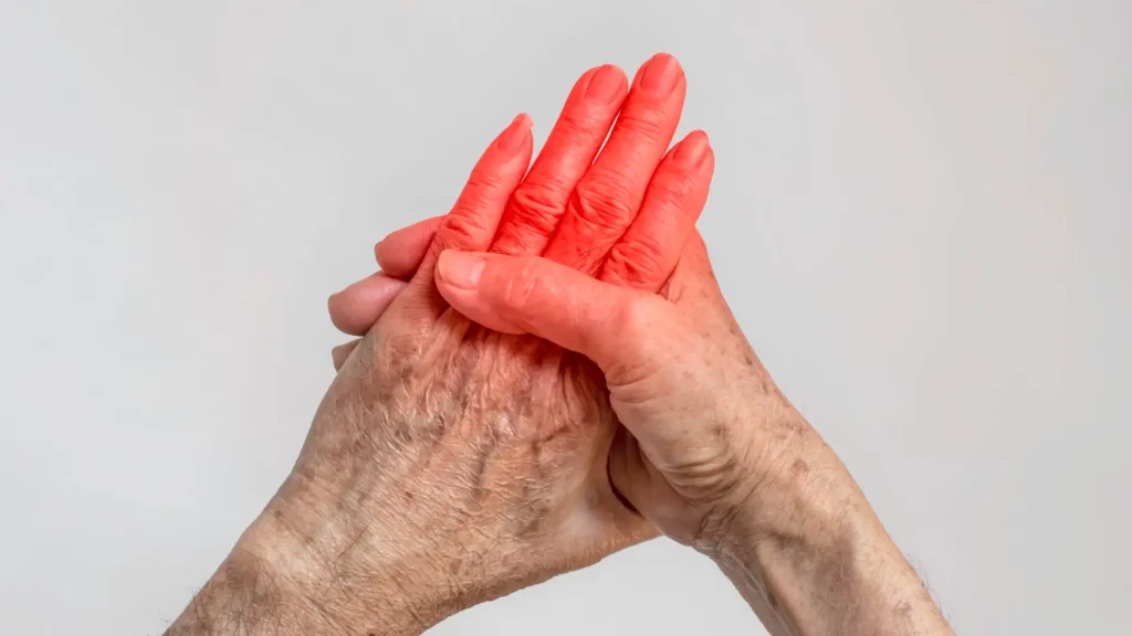 An older individual suffering from rheumatoid arthritis.