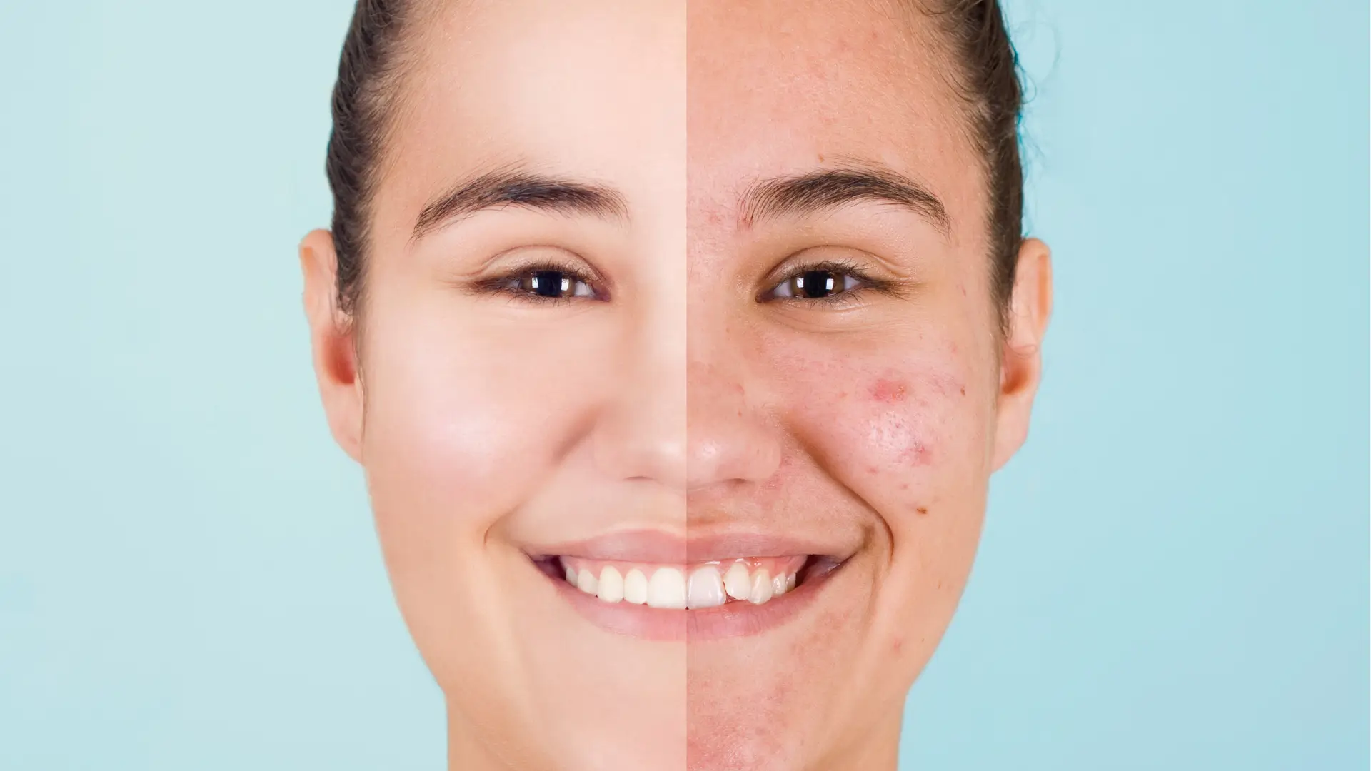 An individual's before and after photo of their facial skin treatment.