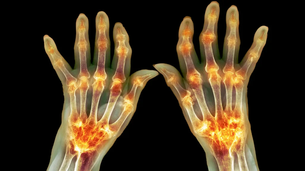 An x-ray of an individual's rheumatoid arthritis.