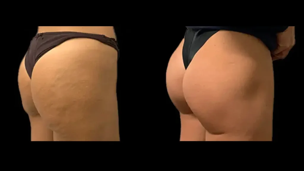 A before and after photo of an individual's buttock lift with Lanluma.