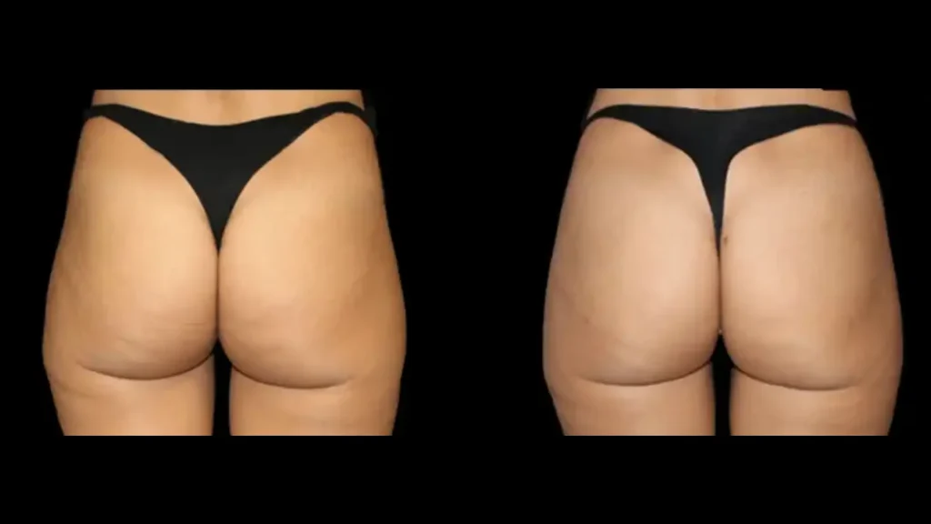 A patient's before and after photo of their Lanluma non-surgical buttock lift.