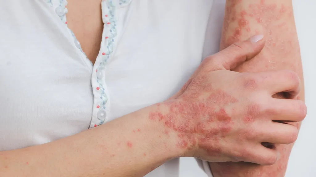 An individual dealing with symptoms of lupus, like skin rashes.