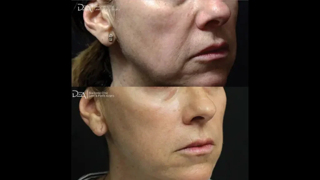 A patient's before and after photo of their non-surgical facial lift with Lanluma.