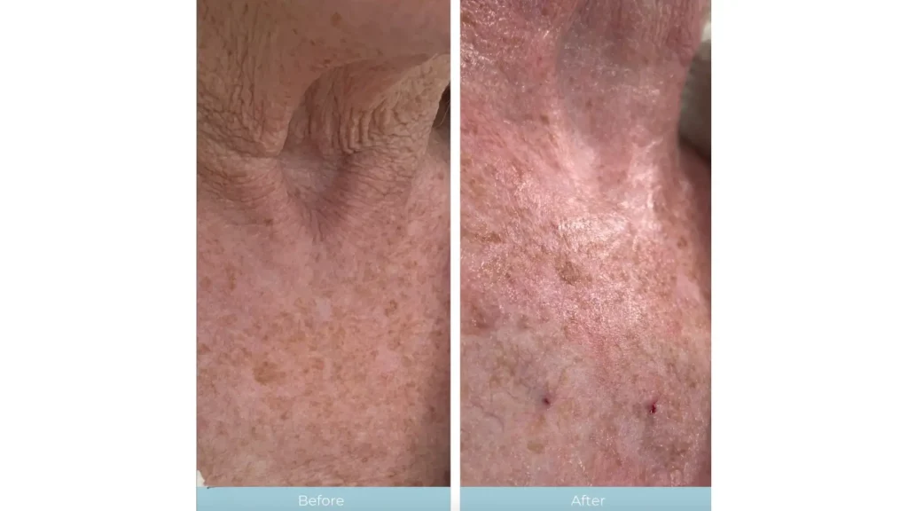 A patient's before and after photo of their Lanluma neck rejuvenation.
