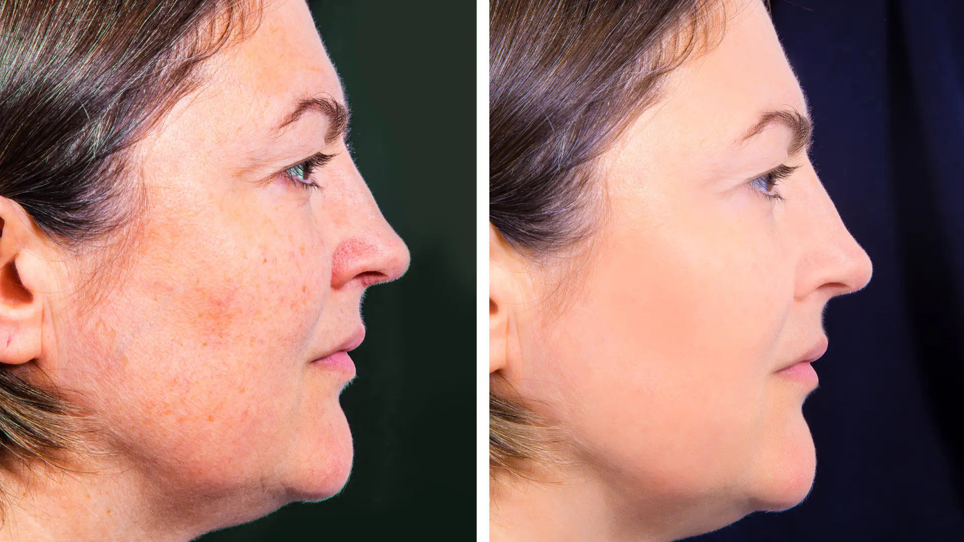 An individual's before and after photo of a facial treatment.