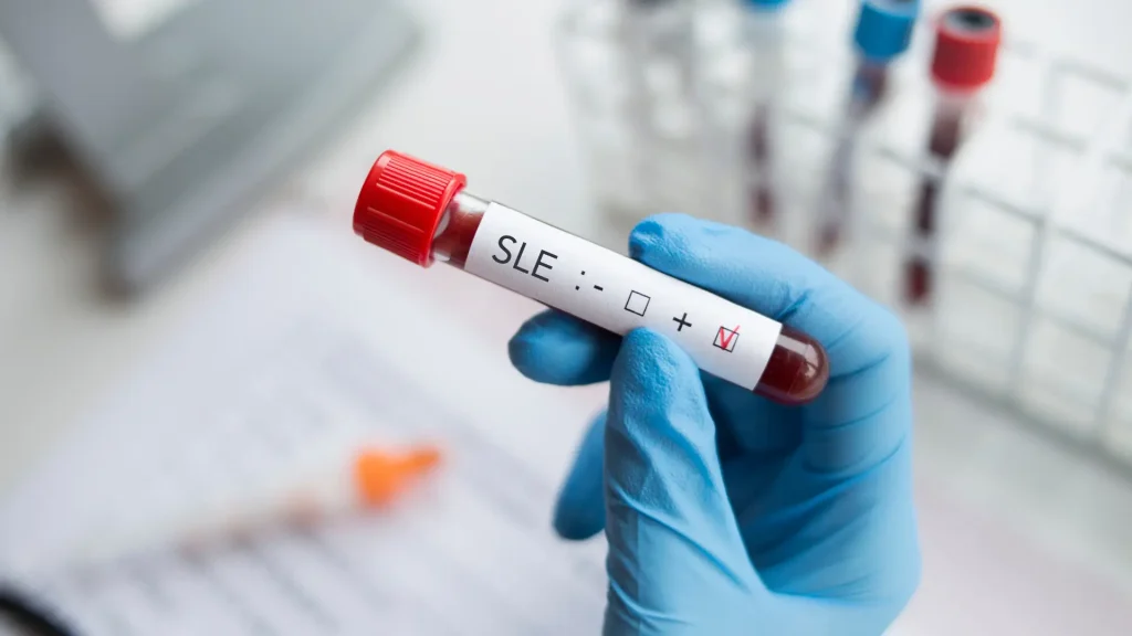 A blood sample of a patient positive with SLE.