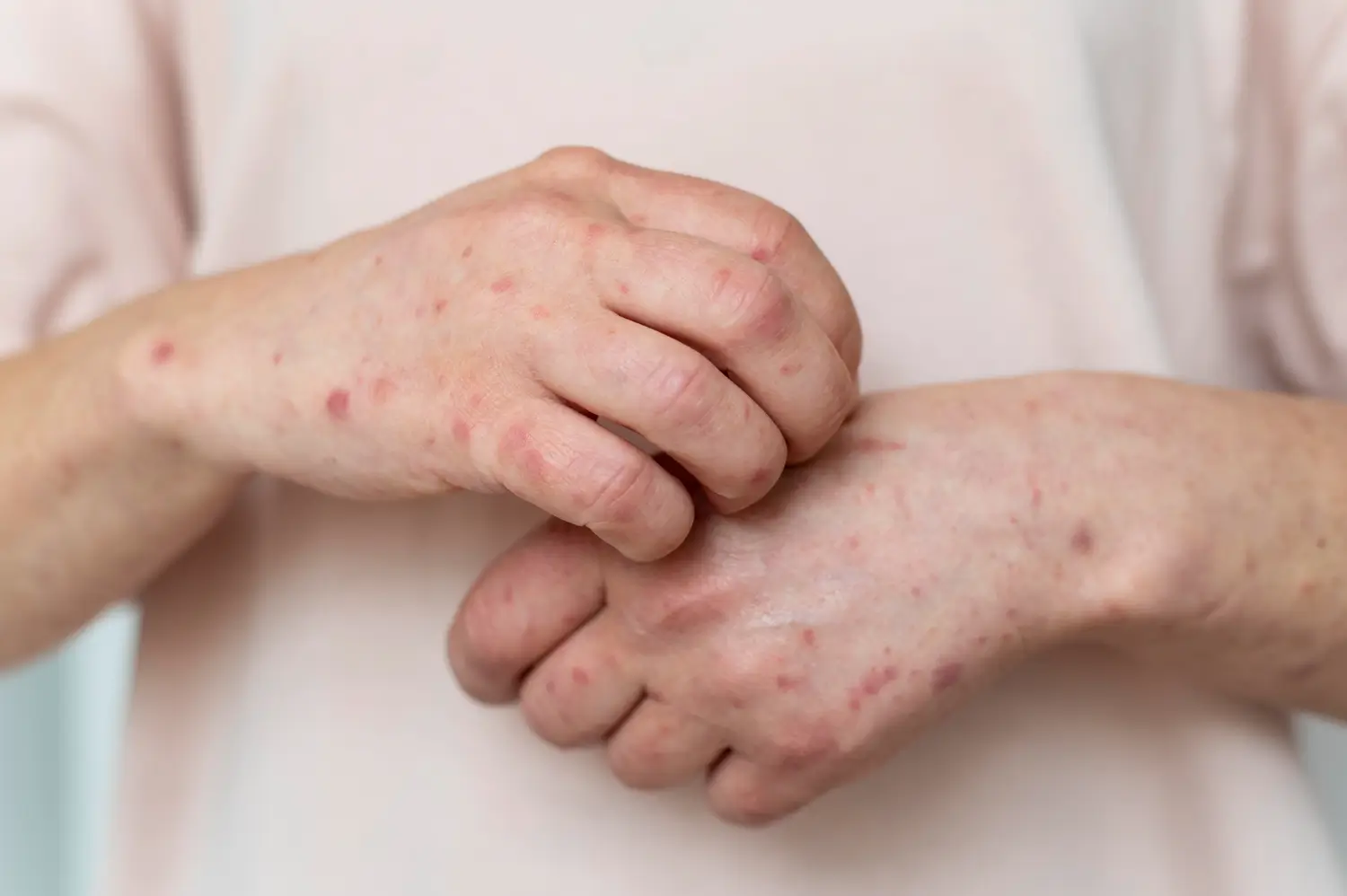 An individual with rashes as a symptom of lupus.
