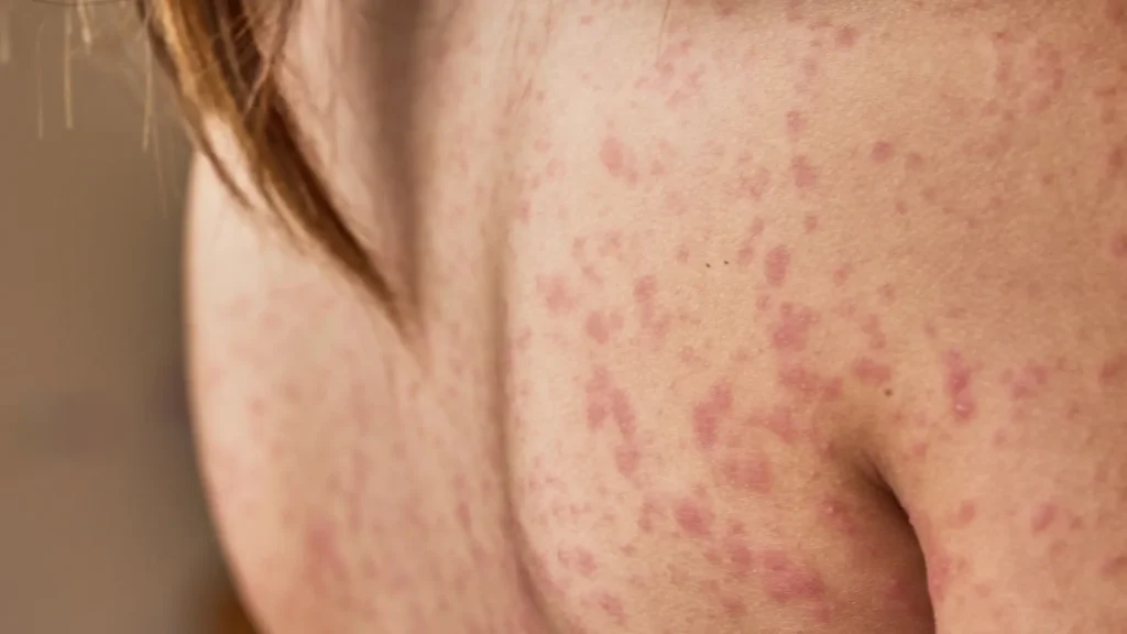 A close-up shot of rashes as the body's allergic reaction.