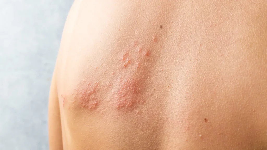 A patient dealing with shingles or herpes zoster on their back.