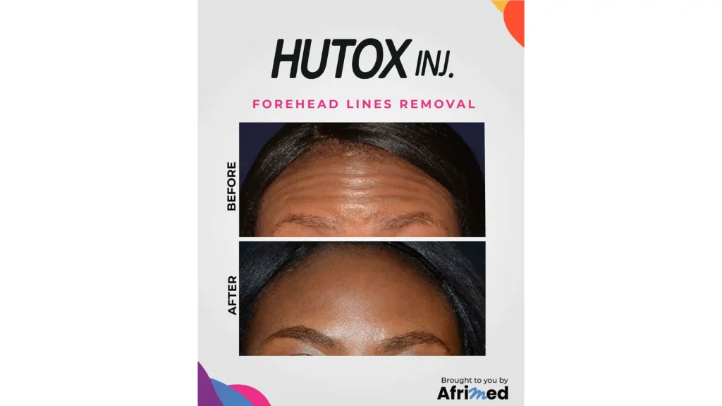 A patient's before and after photo of their forehead treatment using Hutox injection.
