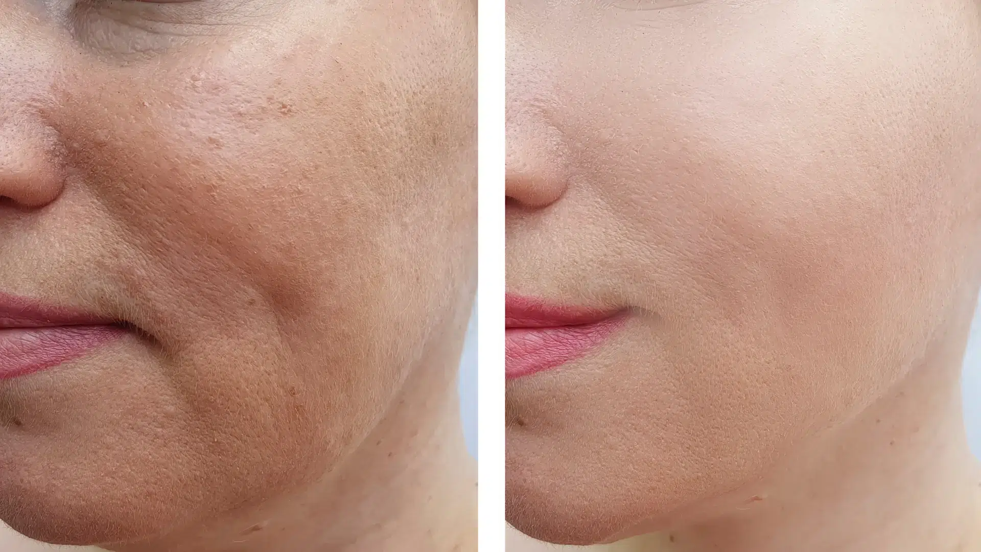 An individual's before and after photo of their facial wrinkle treatment.