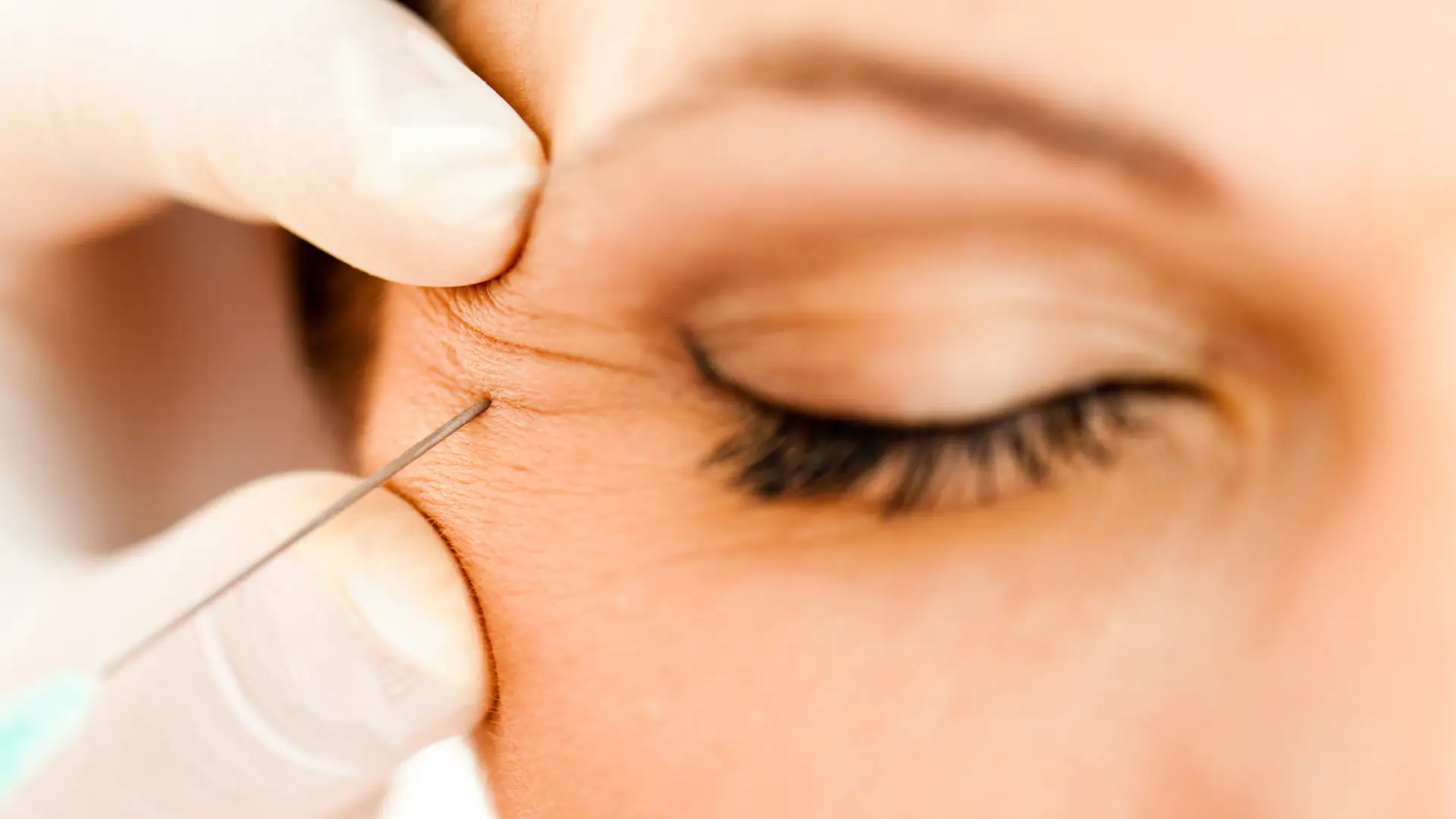 A close-up shot of an individual receiving a botox injection.