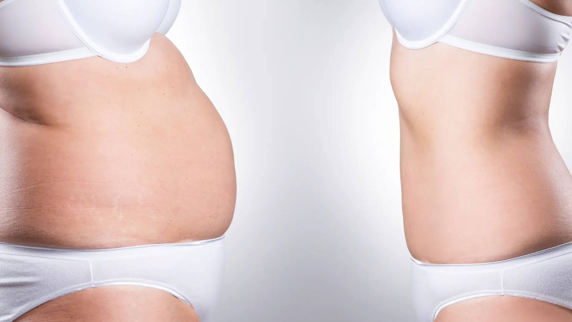 An individual's before and after photo of their fat reduction treatment on their abdomen.