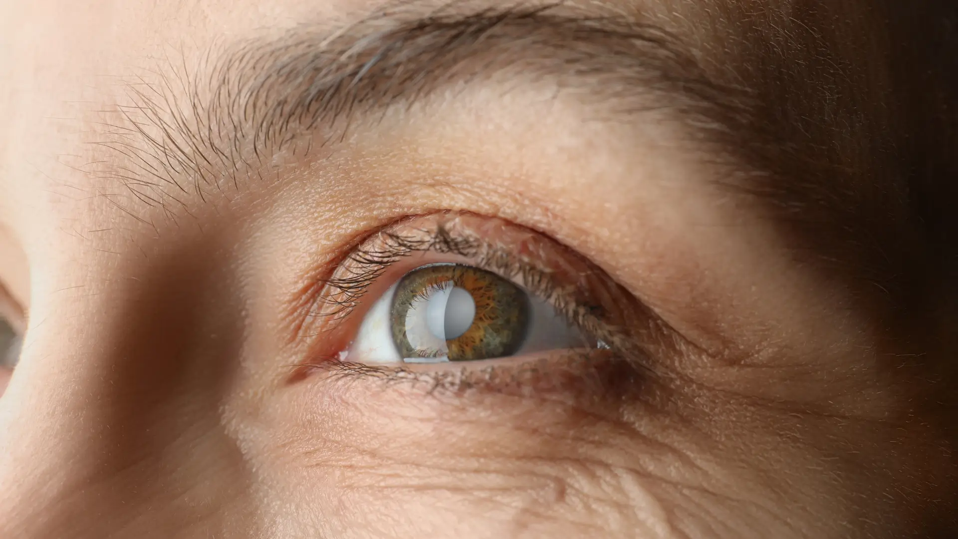 A close-up shot of an individual with cataract.