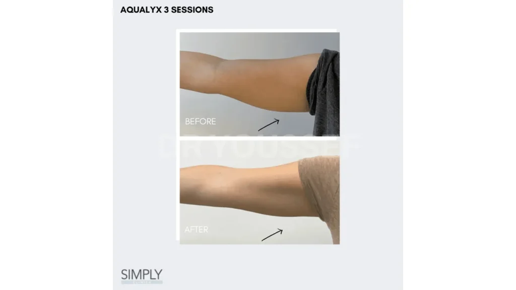 A patient's before and after photo of their upper arm treatment with Aqualyx.