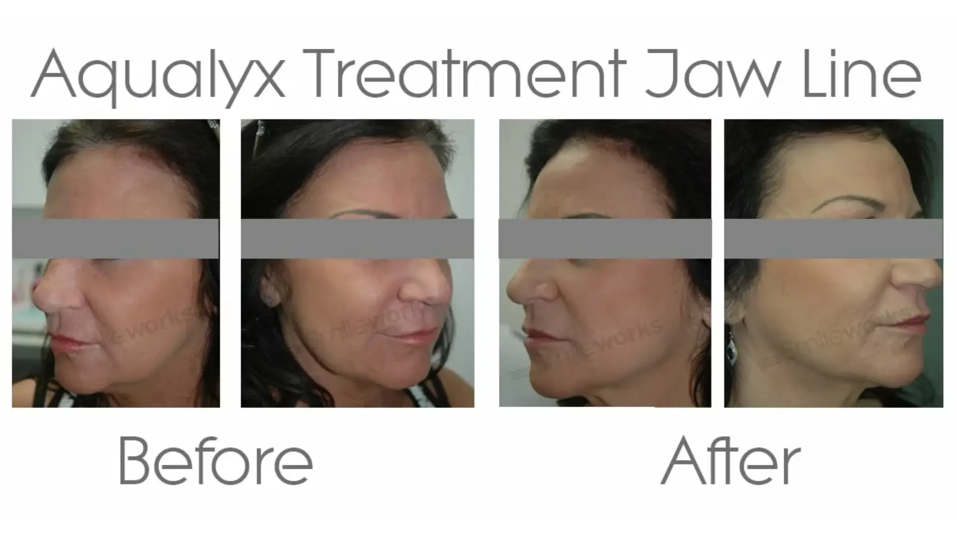 A patient's before and after photo of their Aqualyx jawline treatment.