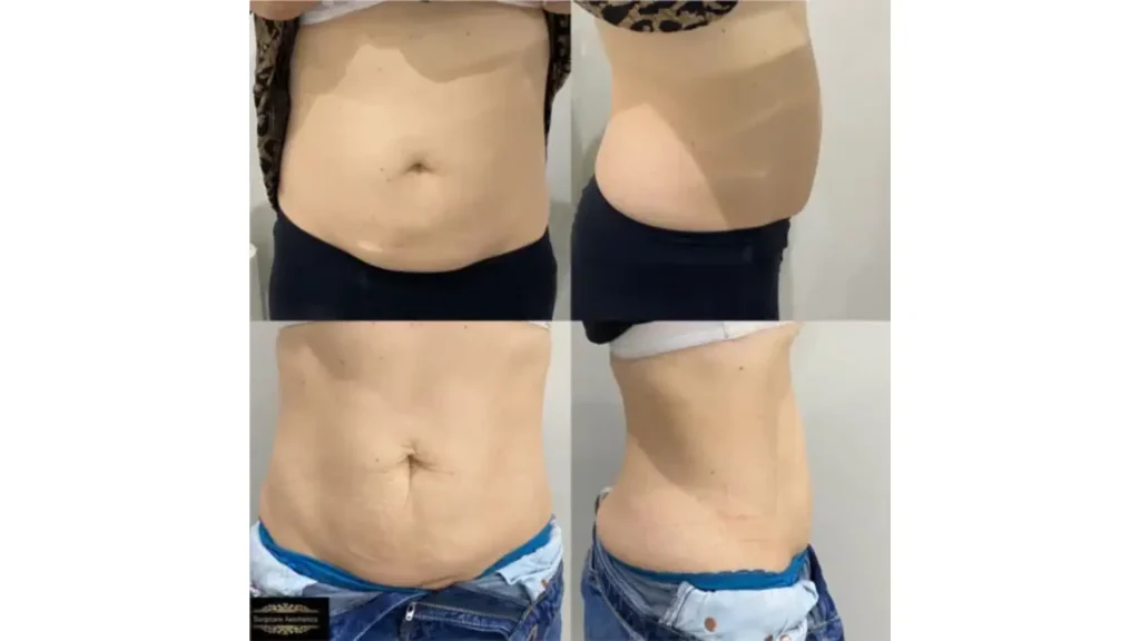 Patients' before and after images of their Aqualyx treatment on their abdomen.
