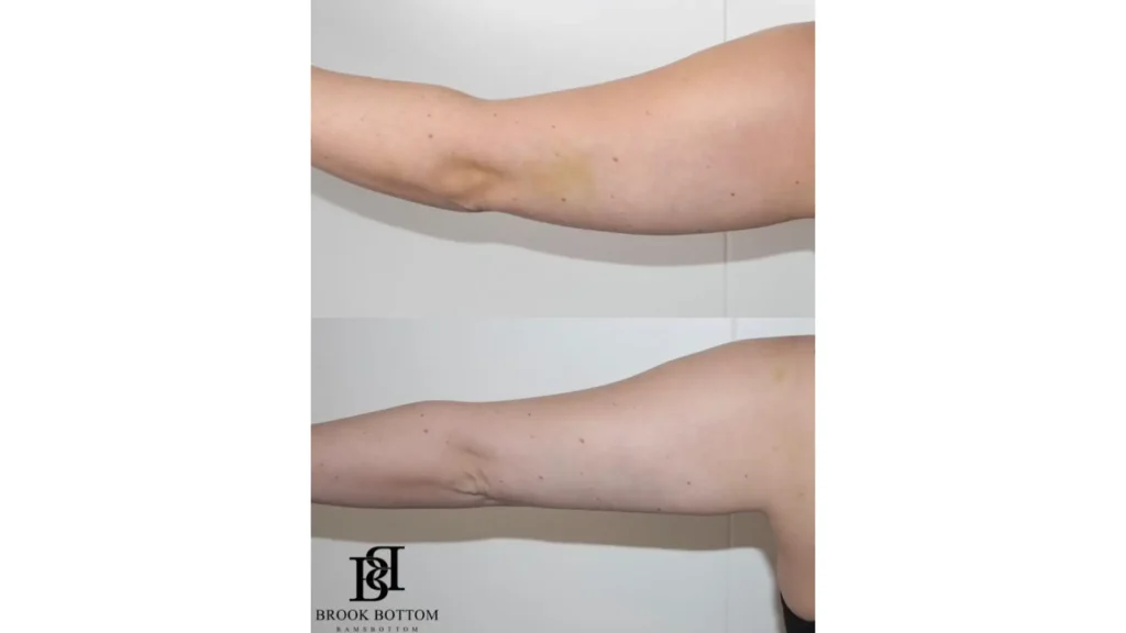 A patient's before and after photo of their Aqualyx arm treatment.