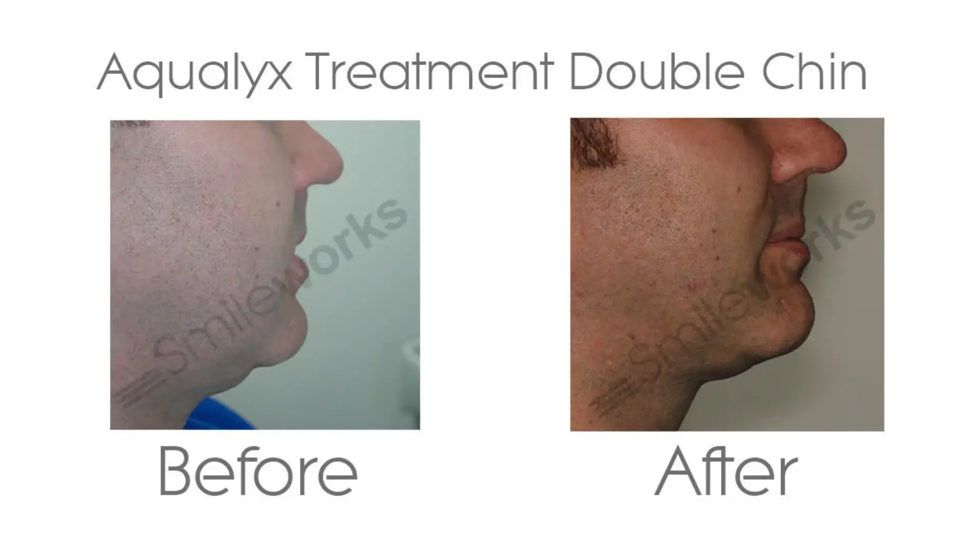 A patient's before and after photo of their Aqualyx double chin treatment.