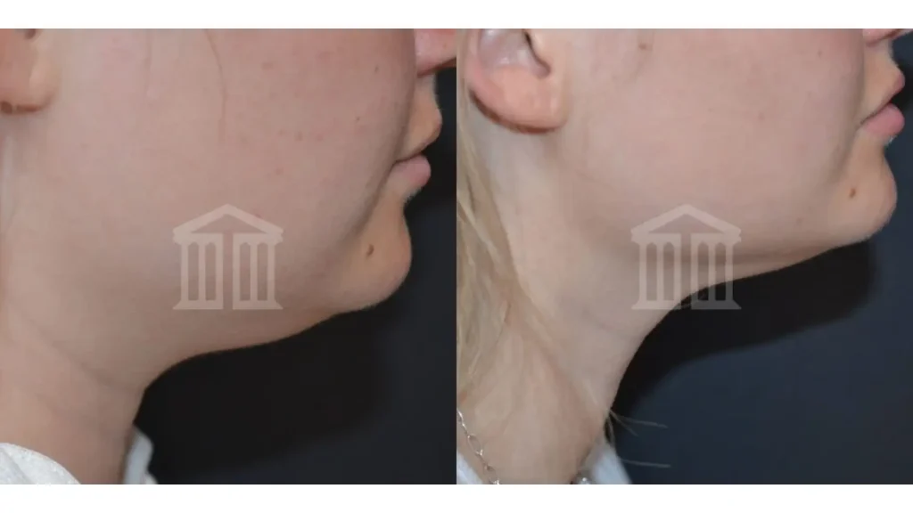 A patient's before and after photo of their double chin treatment with Aqualyx.