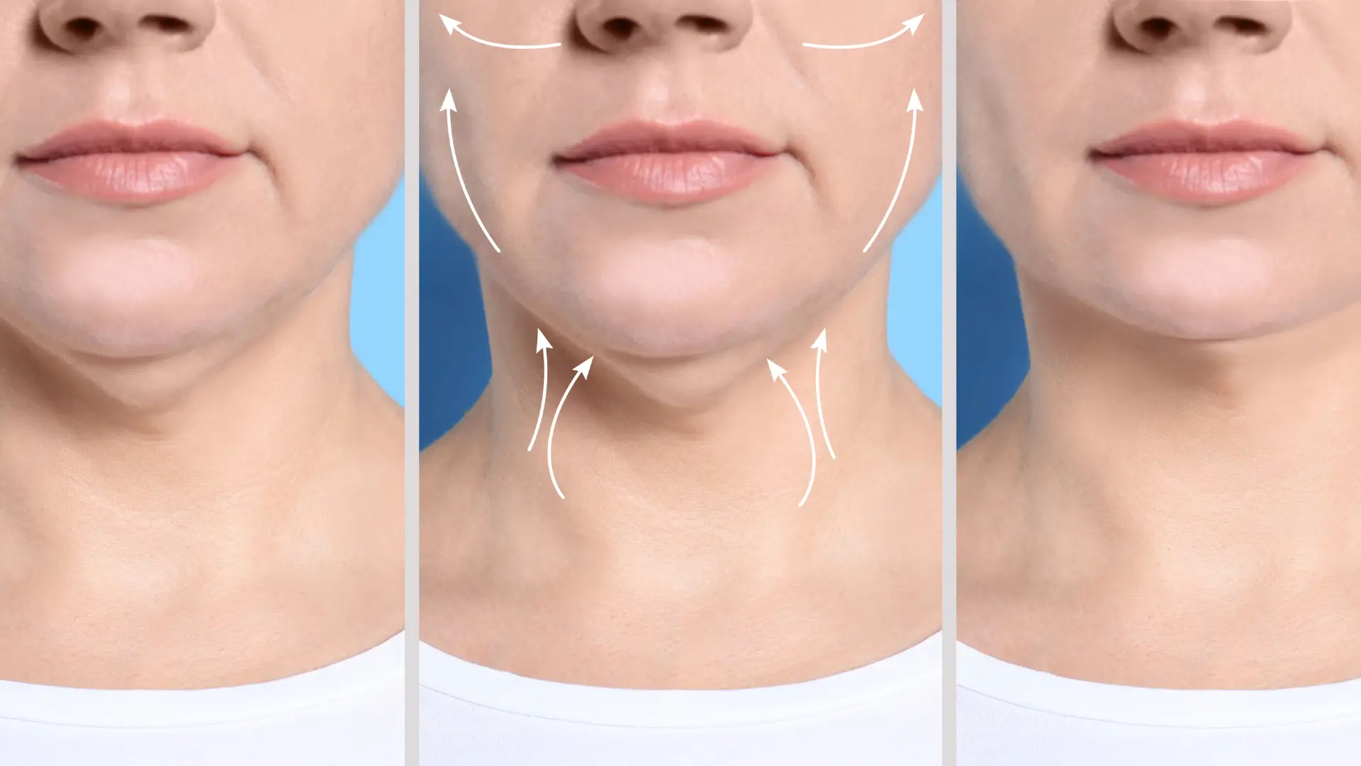 An individual's before and after photo of their double chin treatment.