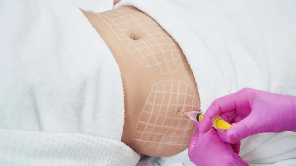 An individual with their abdomen marked with grid mapping technique.