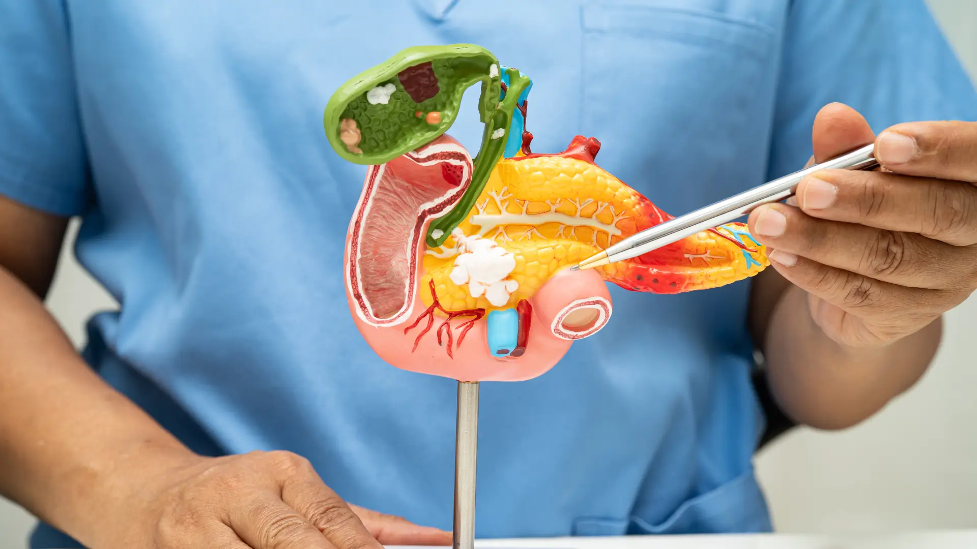 A healthcare provider explaining how pancreatitis happens, which may be associated as one of the severe Ozempic side effects.