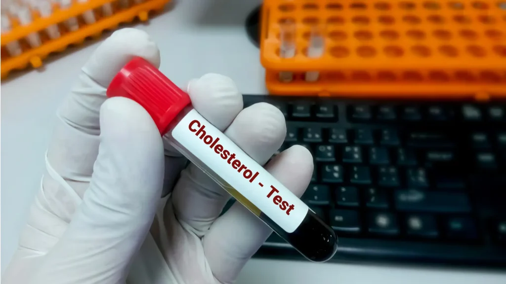 A blood sample for cholesterol testing during a research.