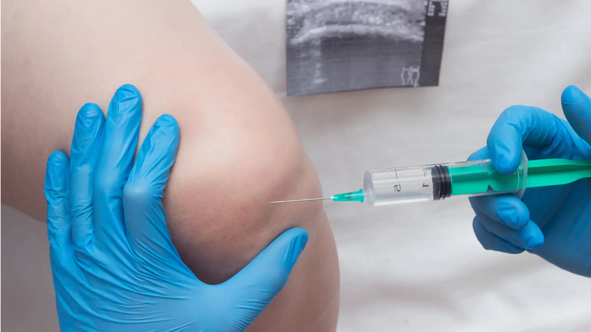 How Much Do Knee Gel Injections Cost.
